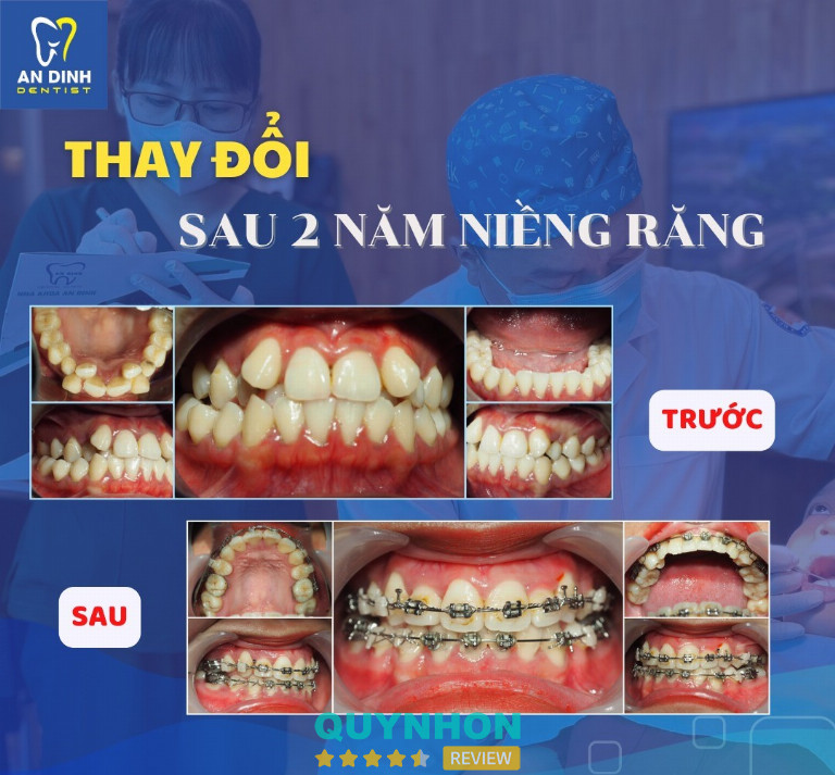 Niềng răng ở Quy Nhơn tại nha khoa An Định