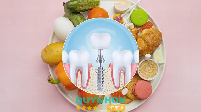 Sau khi cắm Implant có cần kiêng ăn cả đời không