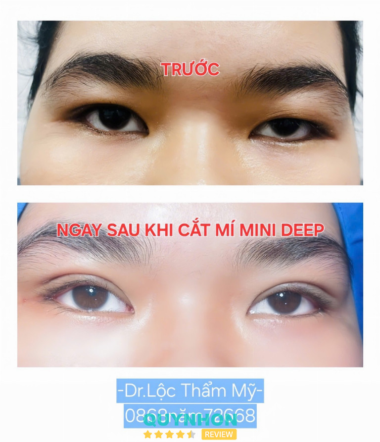 khám mắt tại Quy Nhơn khám mắt tại Quy Nhơn