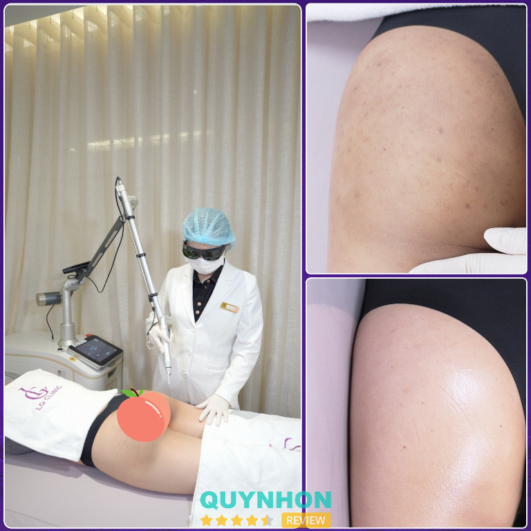 dịch vụ trị thâm body tại LG Clinic dịch vụ trị thâm body tại LG Clinic