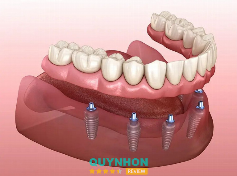 Trồng răng Implant toàn hàm All-on-4/All-on-6 giá bao nhiêu tại Nha khoa Nhân Tâm?