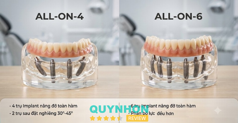 Sự khác nhau giữa All-on-4 và All-on-6 nằm ở số lượng trụ implant