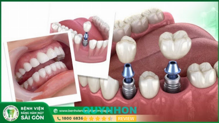 Bệnh Viện Răng Hàm Mặt Sài Gòn đầu tư đồng bộ cho dịch vụ Implant toàn hàm