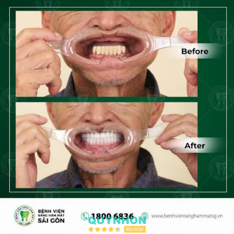 Implant toàn hàm có thể cân nhắc khi mất nhiều răng, sau khi bác sĩ đánh giá