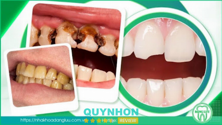 Nha Khoa Đăng Lưu đánh giá tình trạng răng trước khi chọn bọc sứ hay niềng răng